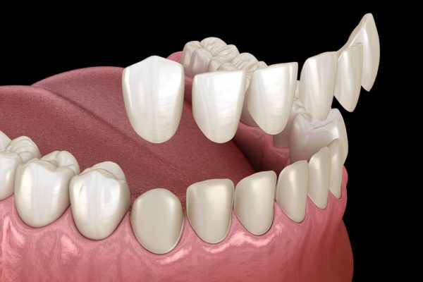 Benefits of Porcelain Veneers vs Composite Veneers: Which Is Better for You?
