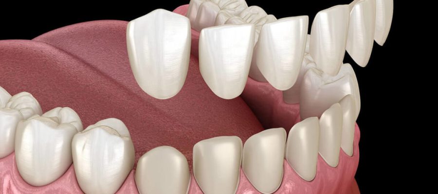 Porcelain Veneers vs Composite Veneers