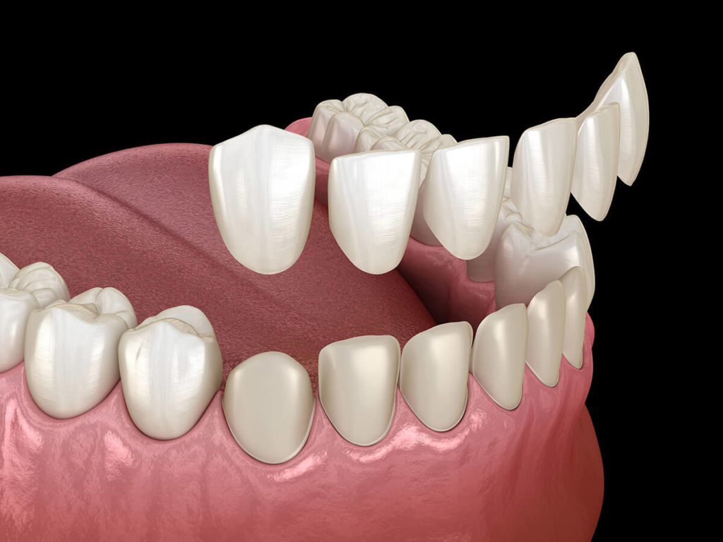 Porcelain Veneers vs Composite Veneers