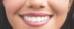 Smile Design