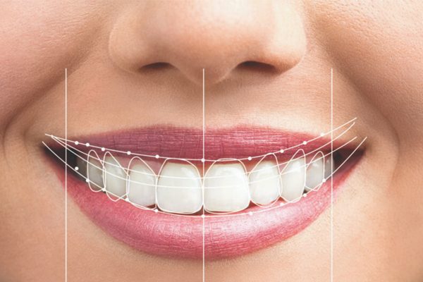 What Is Smile Design? Personalized Aesthetic Solutions at DRGO Smile