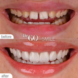 E-max Veneers