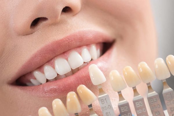 E-max Veneers: The Ultimate Choice for a Natural-Looking Smile