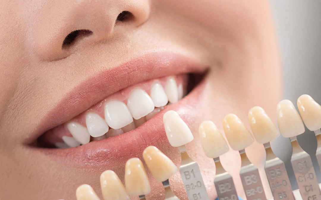 E-max Veneers