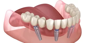 dental implants