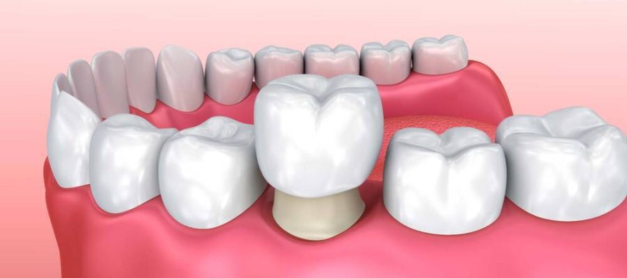 zirconia crowns