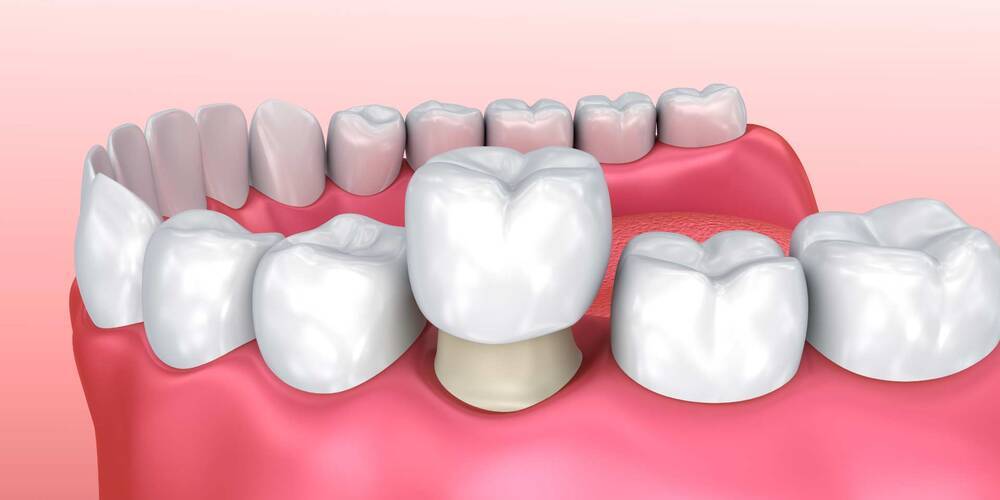 zirconia crowns