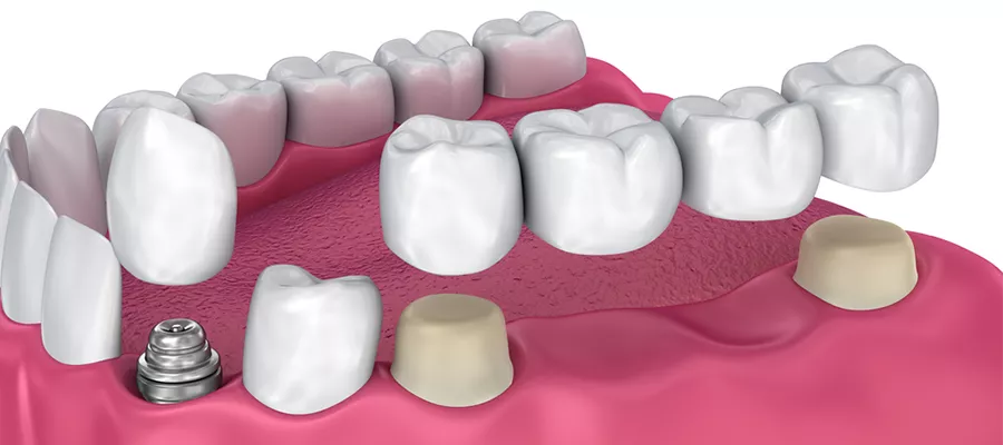 Dental Bridges