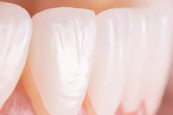 Emax Dental Veneers