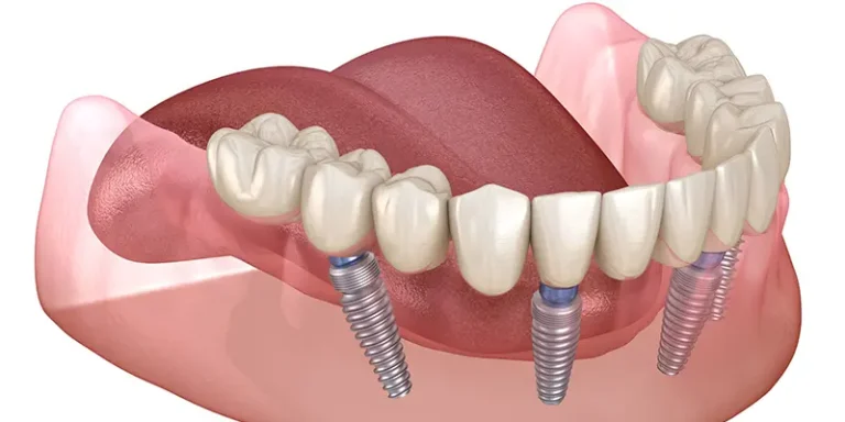 Dental Implants