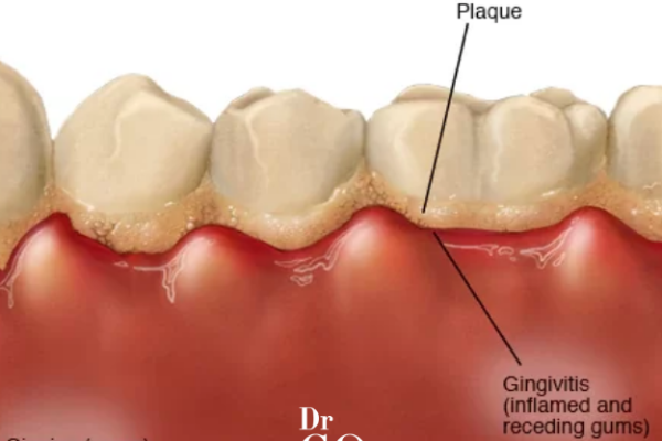 What is Dental Plaque and How it Develops?