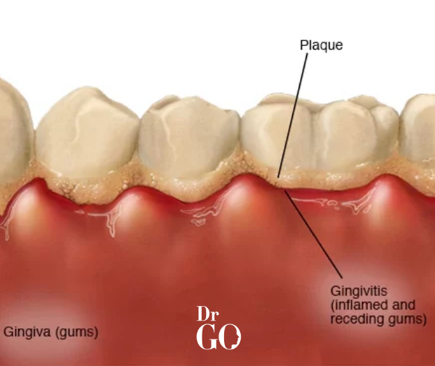 dental plaque