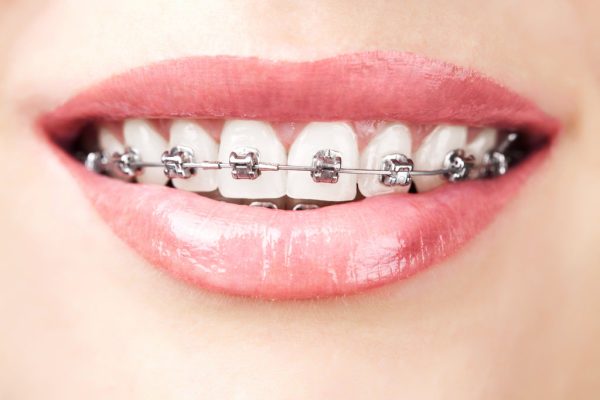 Why Do People Get Braces?