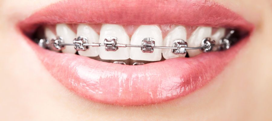 braces