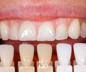 Composite Bonding Turkey