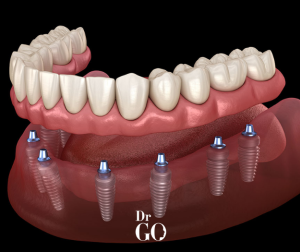 Full Mouth Dental Implants