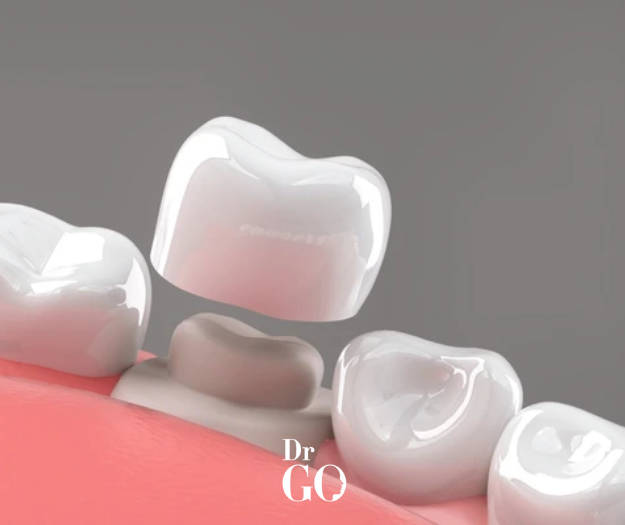 Dental Crowns