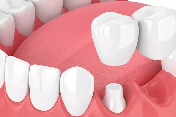Dental Bridges