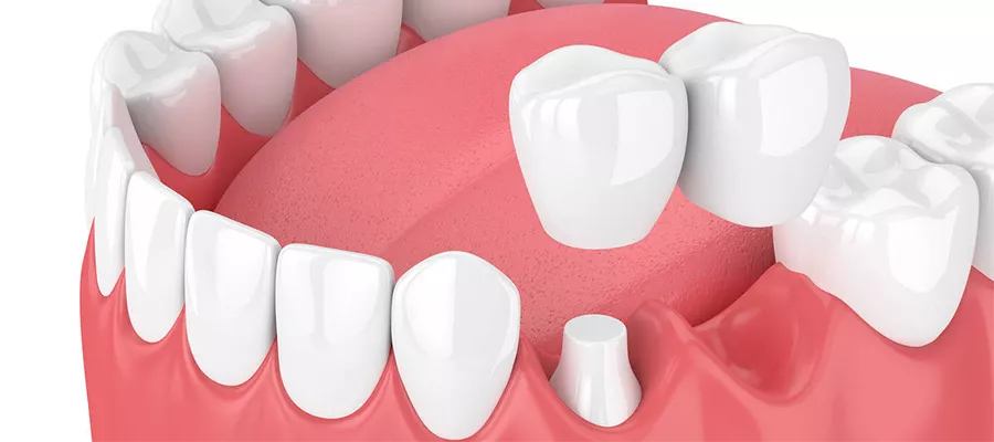 Dental Bridges