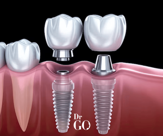 dental implant