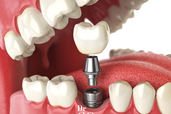Dental Implant Screw Pain: What to Expect