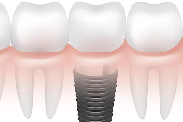 Regain Your Confidence with Dental Implants in Turkey | A Permanent Solution for Missing Teeth