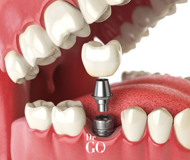 Dental Implant Screw Pain