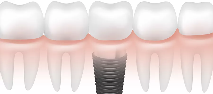 Regain Your Confidence with Dental Implants in Turkey | A Permanent Solution for Missing Teeth