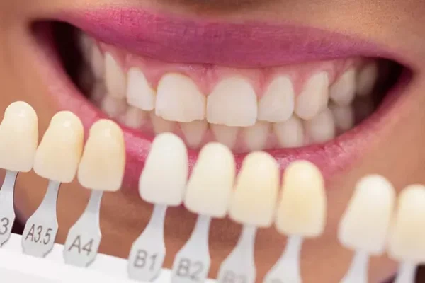 Get a Sparkling Smile with Dental Veneers in Turkey