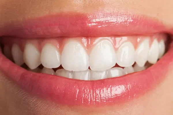 E-max Crowns in Turkey: Discover the Benefits and Elevate Your Smile