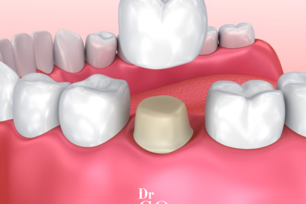 Zirconia or Porcelain: Which Crown Is the Better Choice for Your Smile?