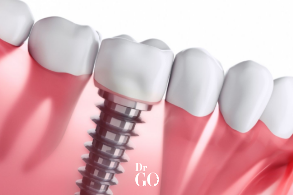 Dental Insurance That Covers Implants