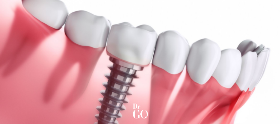 implants