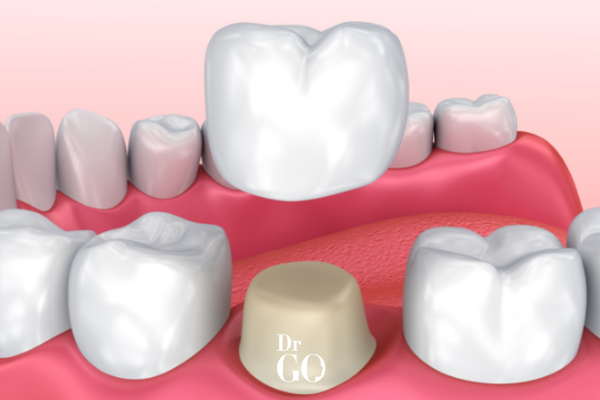 Dental Adhesive for Crowns: What Patients Need to Know