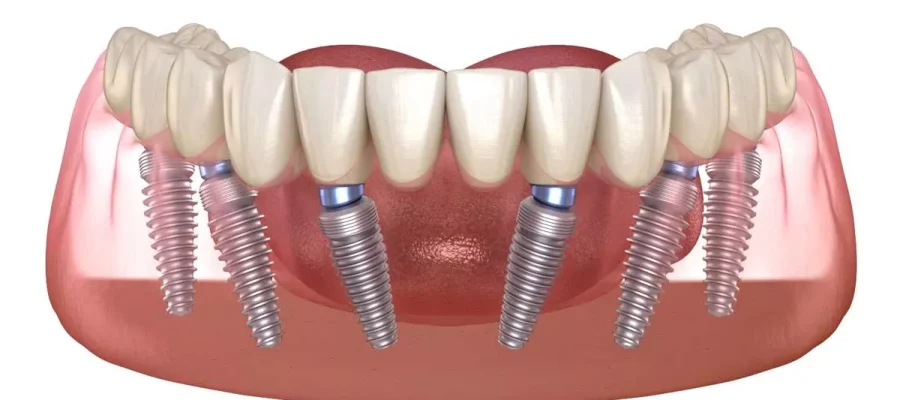 all on six implant