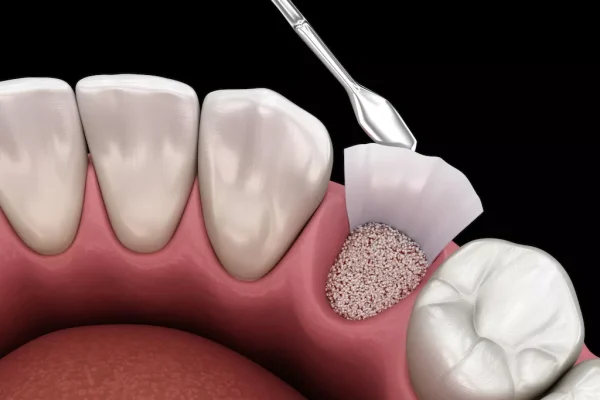 Bone Grafting