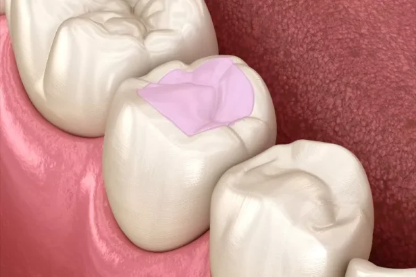 Composite Fillings