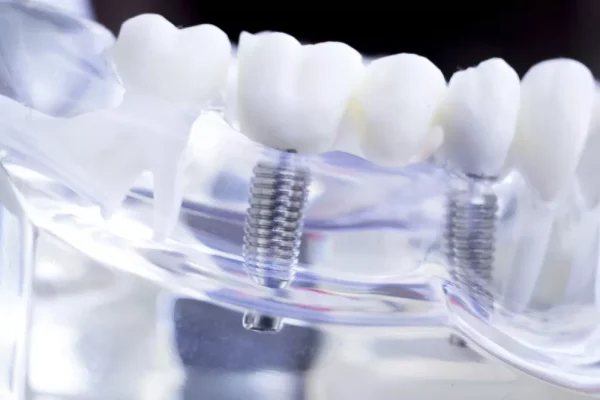 Multiple Teeth Implants