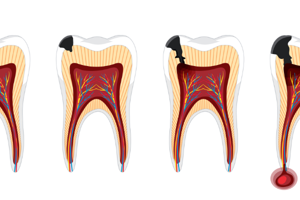 How to Understand if Tooth Decay is Progressing