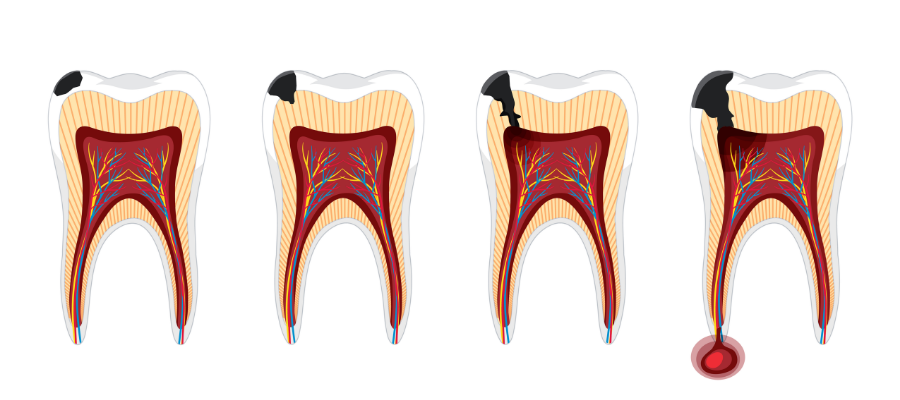 How to Understand if Tooth Decay is Progressing