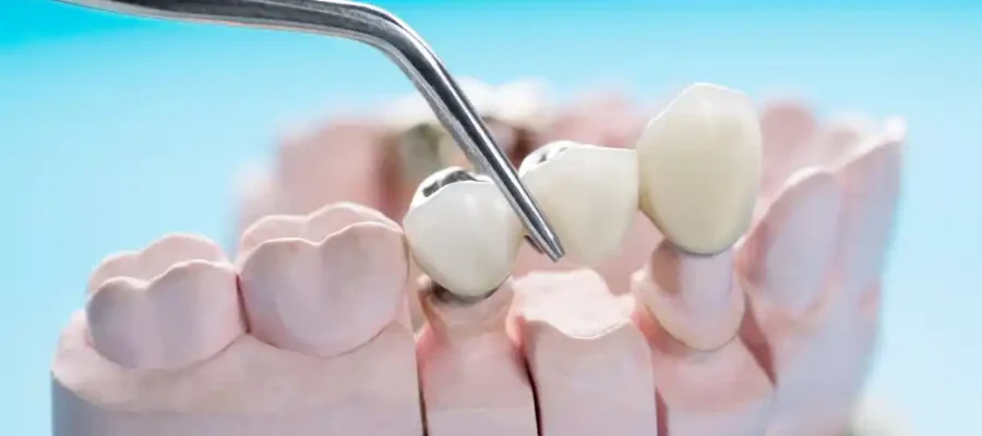 Diş Köprüsü mü İmplant mı Daha Avantajlıdır?